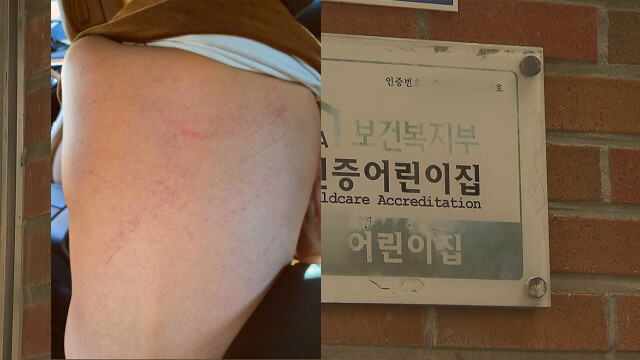 [심층] "가해자는 우리 아이가 피해 사실을 말할 수 없다는 것을 누구보다 잘 알고 있어요"···대구 장애 전담 어린이집서 집단 학대 의혹
